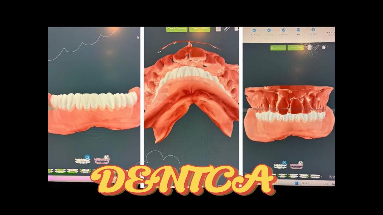 【最新技術】DENTCAで作る入れ歯の設計から完成まで - YouTube