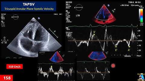 Step By Step RV Evaluation Part 2: TAPSE, TAPSV & RIMP