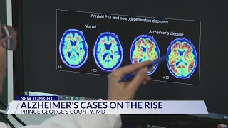 Study: Prince George's County sees rise in Alzheimer's cases