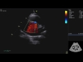 Echocardiography Essentials: Mastering the parasternal short axis (PSAX) view of the aortic valve