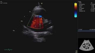Echocardiography Essentials: Mastering the parasternal short axis (PSAX) view of the aortic valve