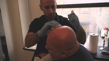 HIS Hair Clinic - New York Hair Loss Clinic for Scalp Micro Pigmentation (Part 1)