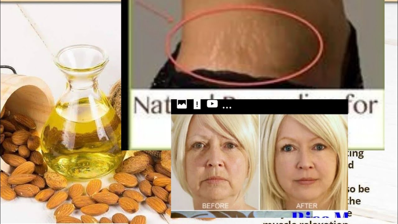 ሸንተረት እና የፊት መጨማደድ ቀረ 
አልመንድ👌👍