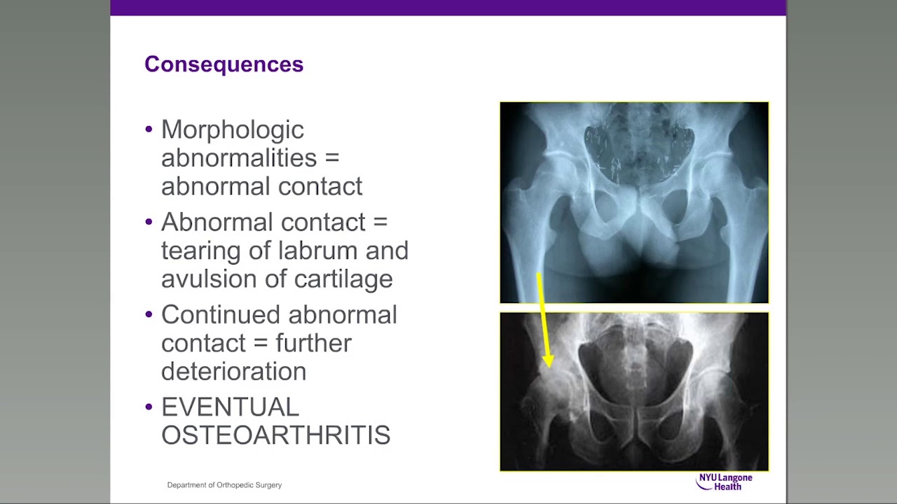 Optimizing The Outcomes In Hip Preservation Nyu Langone Orthopedic Webinar Series Youtube Optimizing The Outcomes In Hip Preservation Nyu Langone Orthopedic Webinar Series Youtube