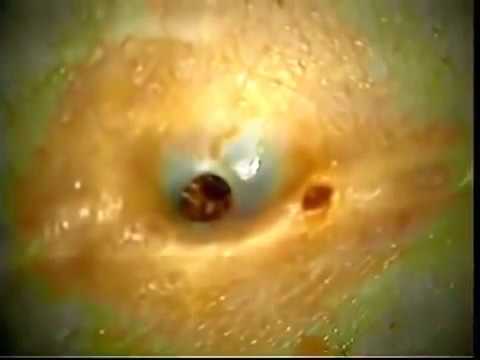 Dilated Pore Of Winer - YouTube