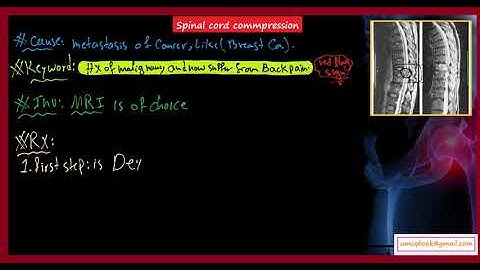 spinal cord compression notes for Australian medical exam MCQ