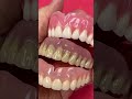 3 different denture characters!