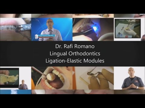 Dr. Rafi Romano - Lingual orthodontics - Ligation Elastic Modules