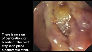 Ampullectomy step by step!