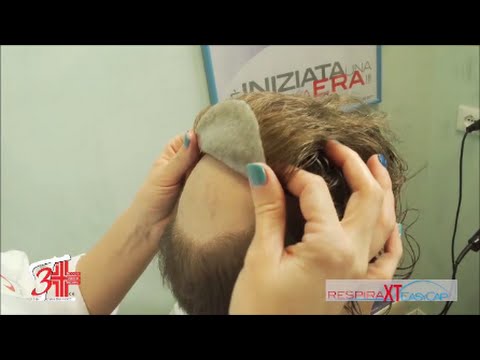 IMPIANTO CAPELLI UOMO 3T IONIX | Sicurmed - YouTube