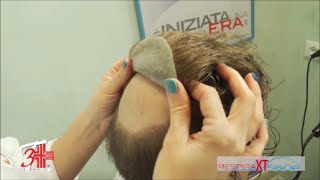 Impianto Capelli Uomo 3T Ionix Sicurmed