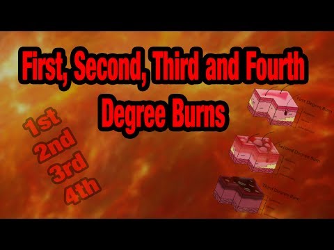 Video: Degree Of Burns - 1, 2, 3 And 4 Degree Of Burn, Signs And Symptoms