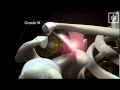 Acj dislocation mechanism shoulderdoc