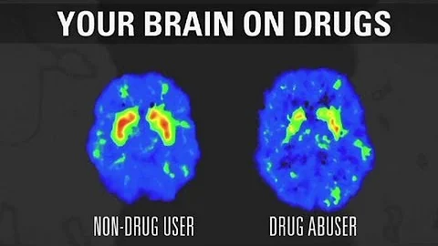 How addiction changes your brain - DayDayNews