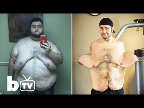 My 300lbs Weight Loss Left Me With 13lbs Of Loose Skin