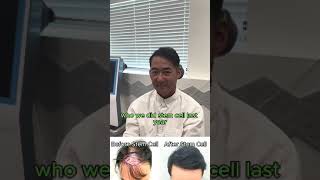 Stem cell Hair Restoration for hair loss 1 YEAR  FOLLOW UP with before and after photos