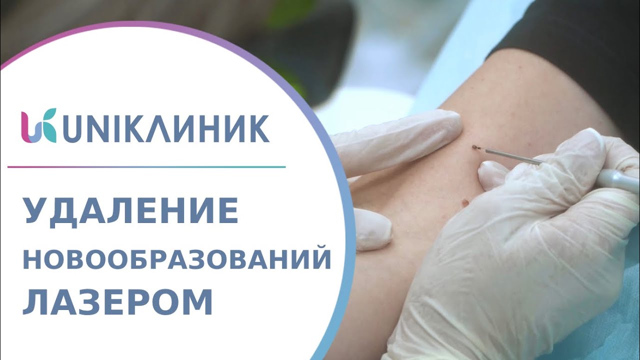 🩹 Что нужно знать о лазерном удалении новообразований? Удаление ...