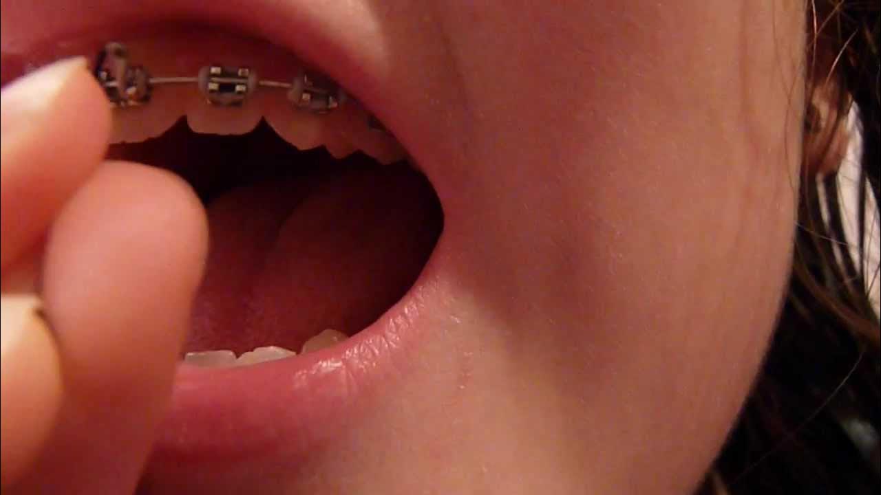 Removing Brace Elastics AT HOME YouTube