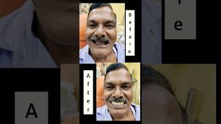 Complete Denture🦷😍✅#completedenture #youtubeviral#dentaltreatments#dentist#teeth#dentalsolutions