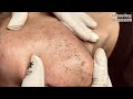 Relaxing acne treatment 95  he was introduced to linh by a friend