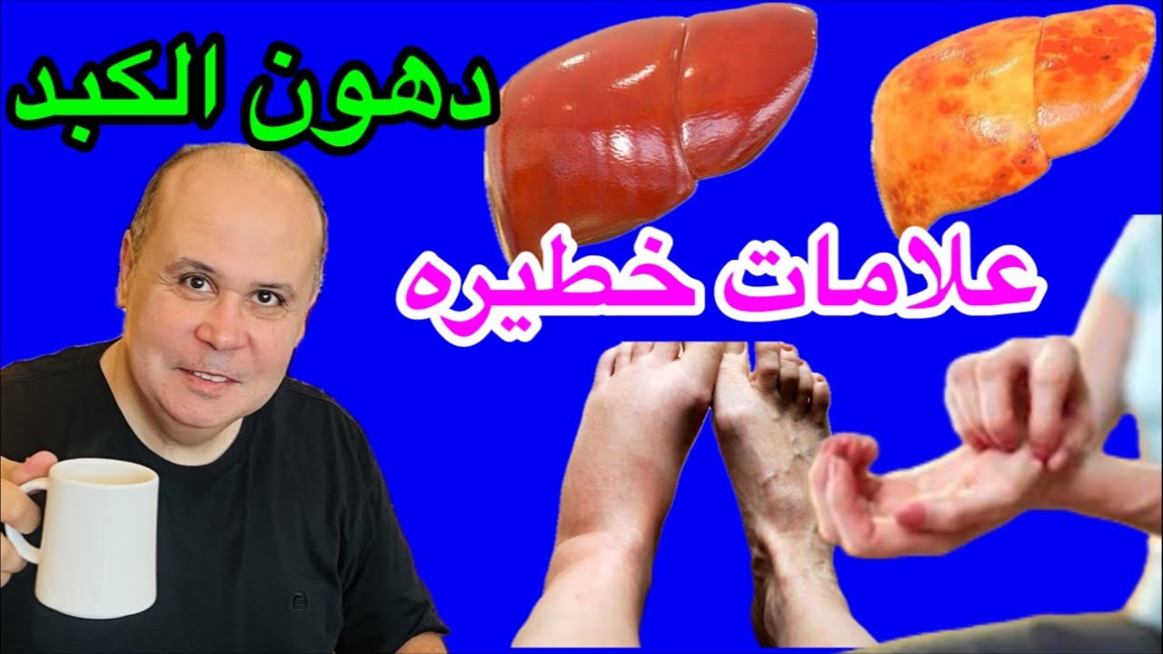 ٩علامات خطيره لدهون الكبد…٦طرق بمكونات طبيعيه في منزلك للتخلص من دهون الكبد..FATTY LIVER