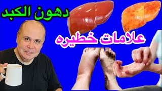 ٩علامات خطيره لدهون الكبد٦طرق بمكونات طبيعيه في منزلك للتخلص من دهون الكبد..FATTY LIVER