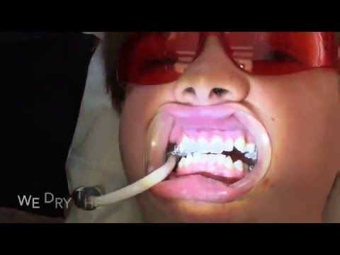 Getting your braces on with Cordell