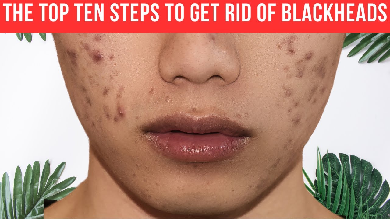 How To Get Rid Of Vlack Heads (step-by-step Guide)