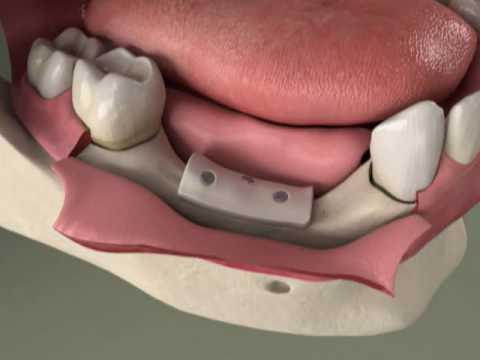 Video: Endosteal Implants: Zobu Implanta Veidi Un Procedūras