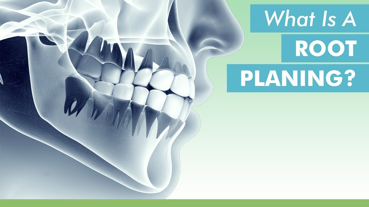 What Is A Root Planing? YouTube