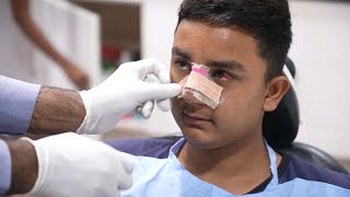 Bend Nose Corrected using Rhinoplasty | Splint Removal | Recovery | Before & After