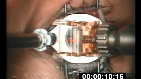 LASIK - Dr. N. Gabric - OUP SBK Flap creation - MORIA