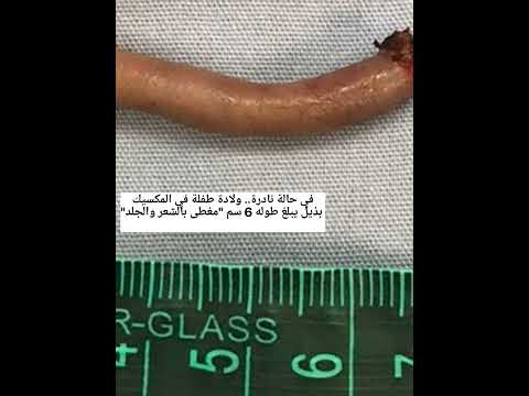 في حالة نادرة ولادة طفلة في المكسيك بذيل يبلغ طوله 6 سم مغطى بالشعر والجلد