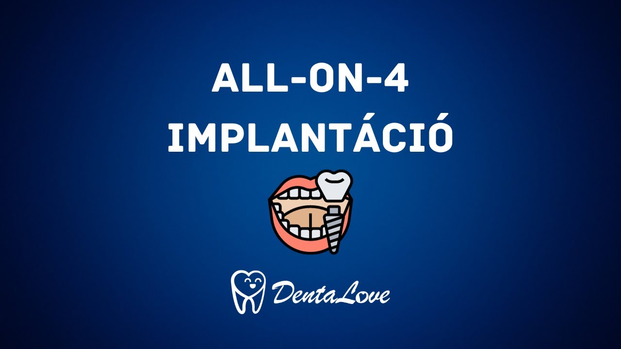 Teljes implantáció - All-on-4 technológiával