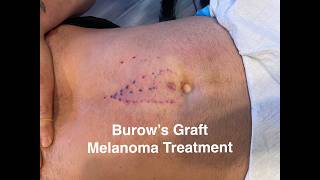 Burow's Graft | Melanoma Treatment