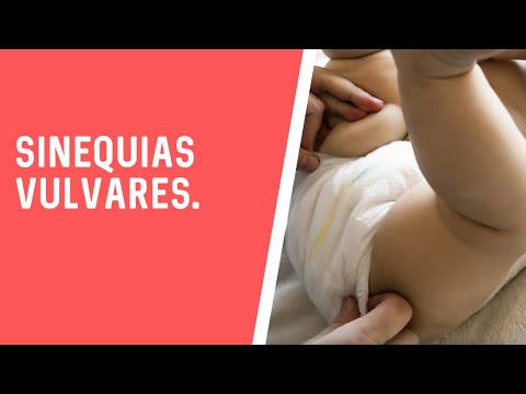 Vídeo: Sinequias En Niños - Sinequias Del Prepucio