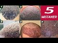 5 Mistakes in a freshly transplanted Hairline!!!