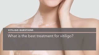 What is the best treatment for vitiligo?
