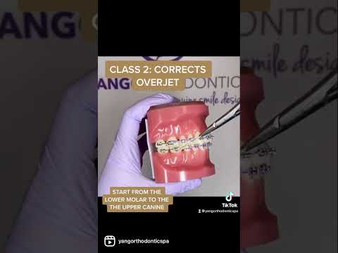 Different Classes of Orthodontic Elastics