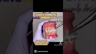 Different Classes of Orthodontic Elastics