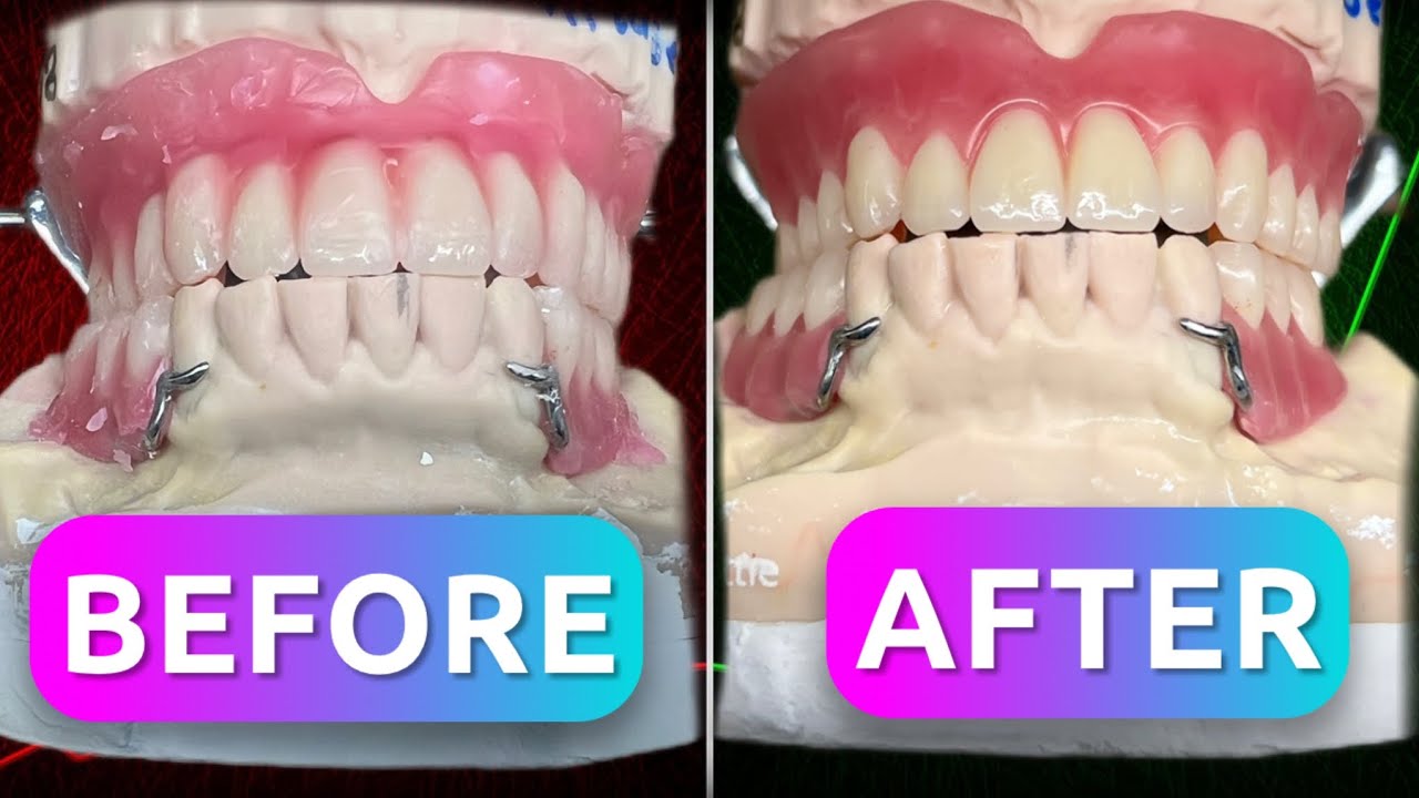 Dental Lab Wax-Up Technique | Upper Full & Lower Partial Denture