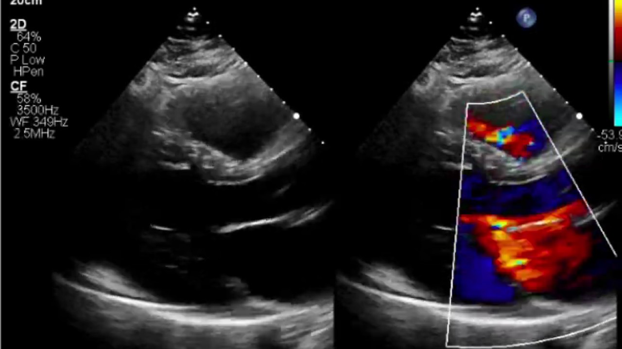 2-D echocardiography showing severe global hypokinesia and left