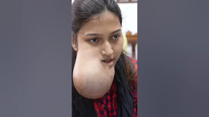 Poor Girl with very huge Face Tumor #shorts #medical - DayDayNews