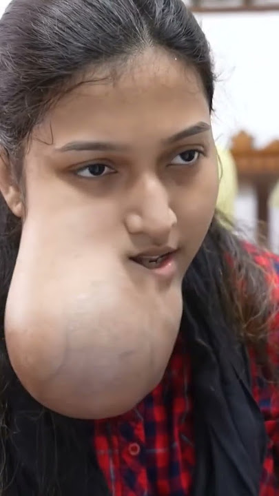 Poor Girl with very huge Face Tumor #shorts #medical