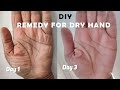 Home remedy for dry hands - dry skin removal | easy home remedy for dry cracked hands