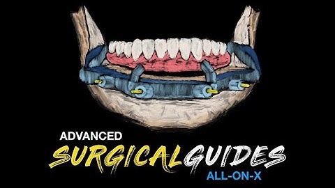 How to Align a scan with CBCT for full arch All on X