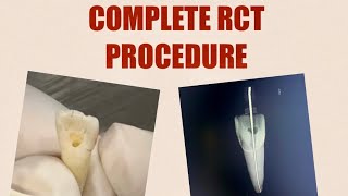 COMPLETE RCT PROCEDURE| Stepwise tutorial of RCT from Access cavity to Obturation