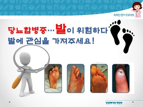[당뇨질환] 당뇨병성 족부병변