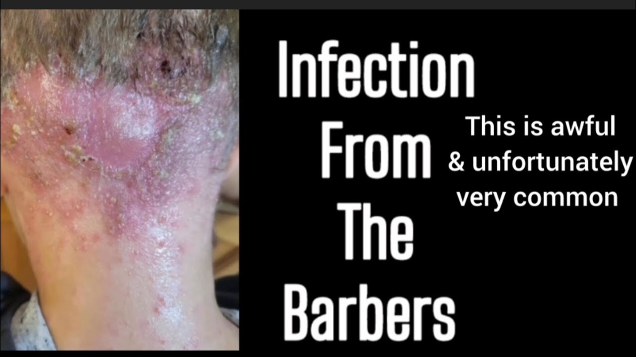 infection from the barbers! - YouTube