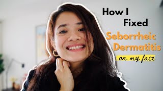 How to Treat Seborrheic Dermatitis On The Face | Personal Tips & Hacks